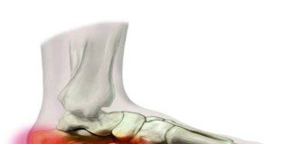 Talagia, el dolor del talón